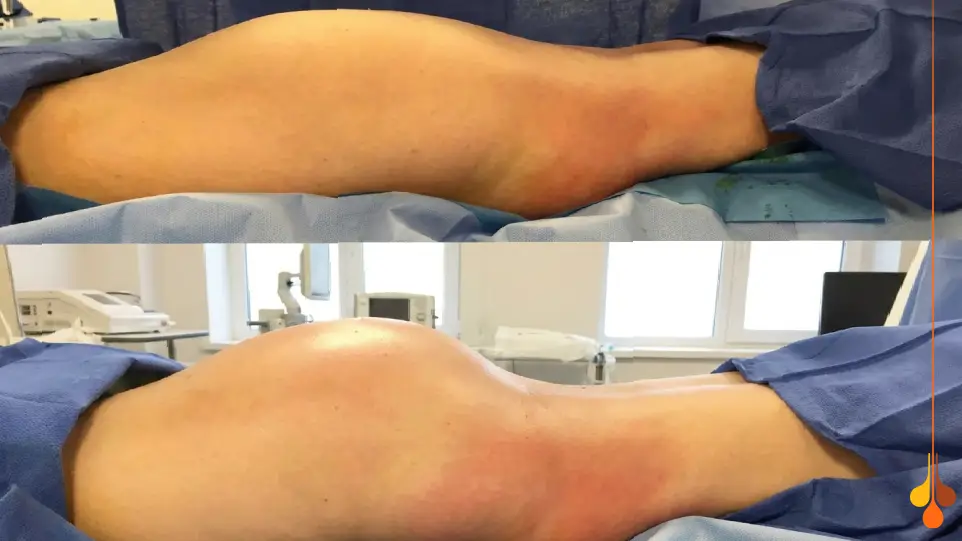 تزریق چربی به باسن یکی از روش های بزرگ کردن باسن