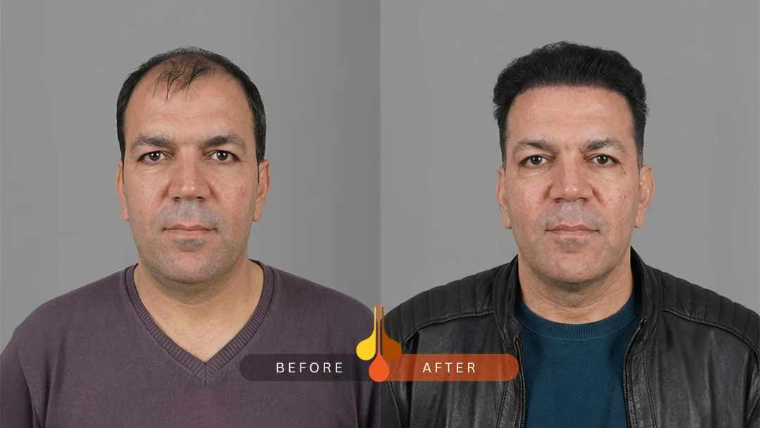 نمونه کاشت مو در کلینیک فخرائی