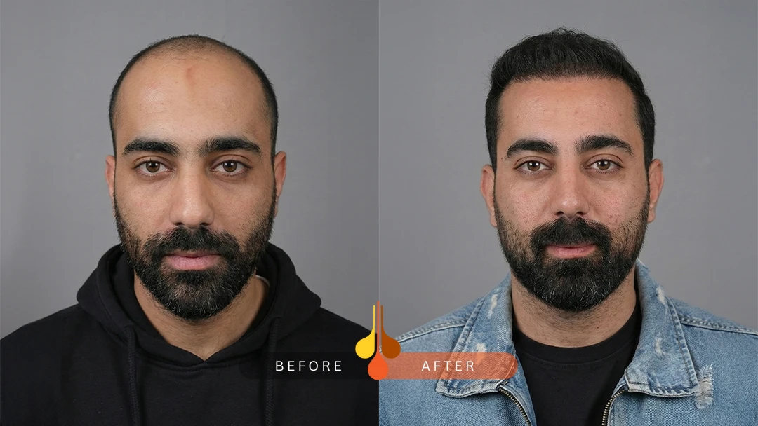 نمونه کاشت مو در کلینیک فخرائی