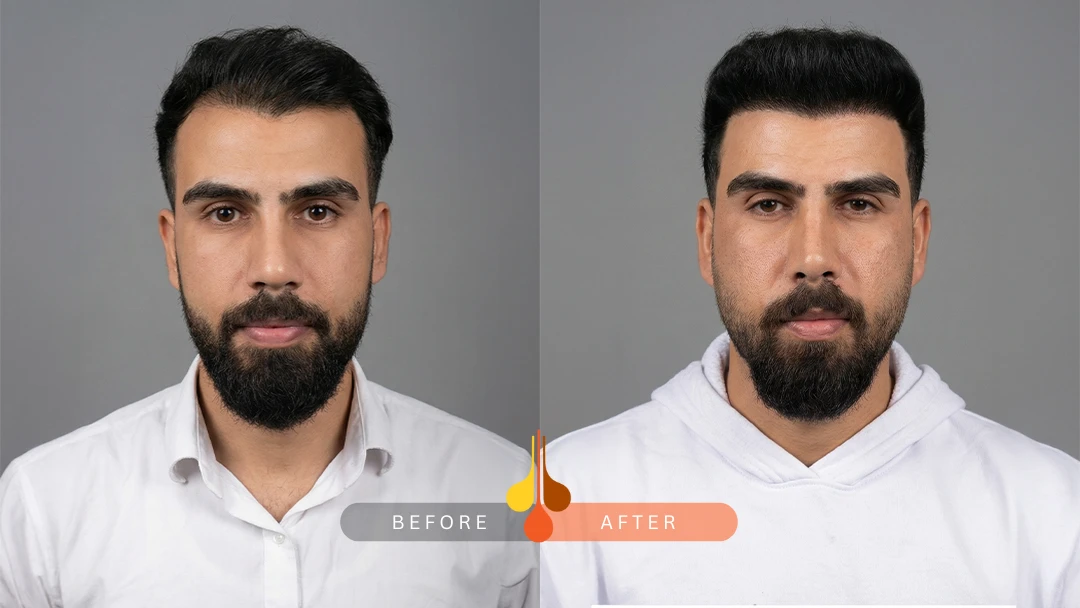 نمونه کاشت مو در کلینیک فخرائی