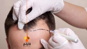 بهترین روش کاشت مو در سال ۱۴۰۴