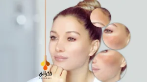 ملانین صورت