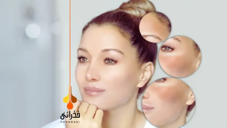 ملانین صورت