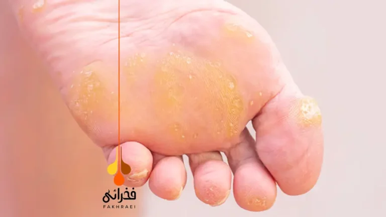 هیپرکراتوزیس