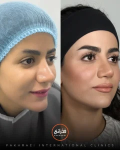 کاشت مو کلینیک فخرایی به روش ntf 