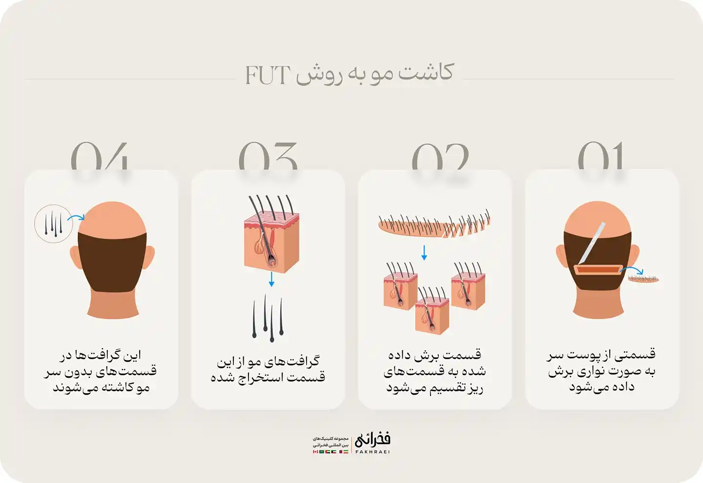 روش FUT در کاشت مو