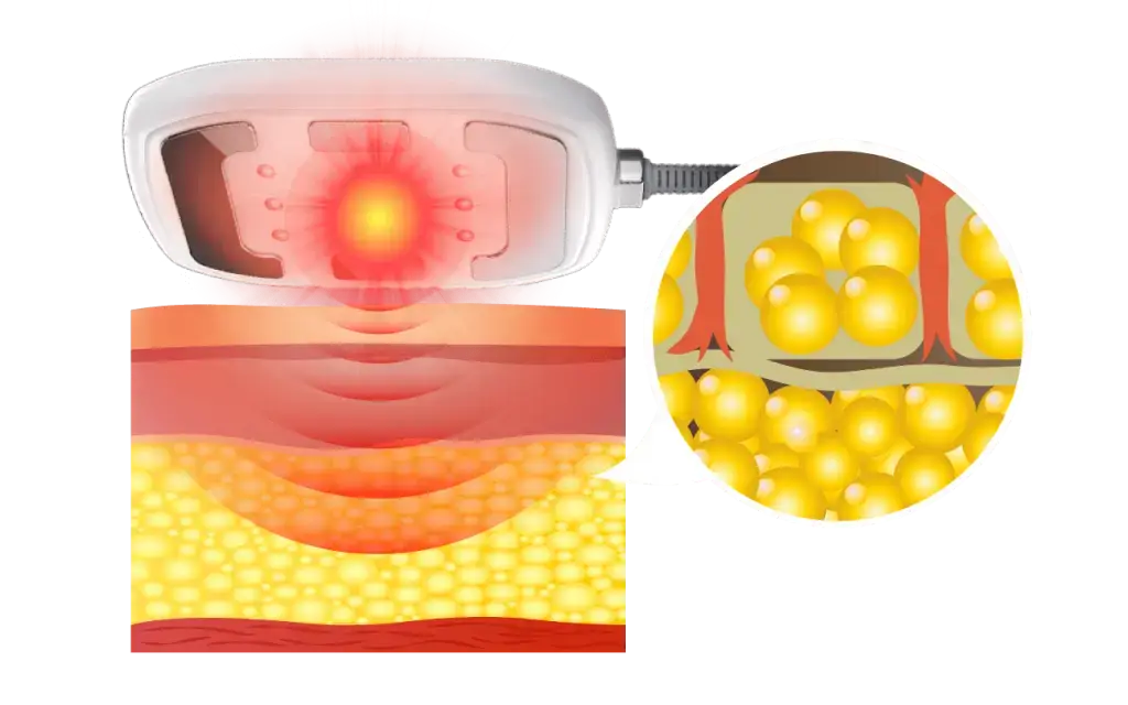نحوه عملکرد دستگاه ترواسکالپ