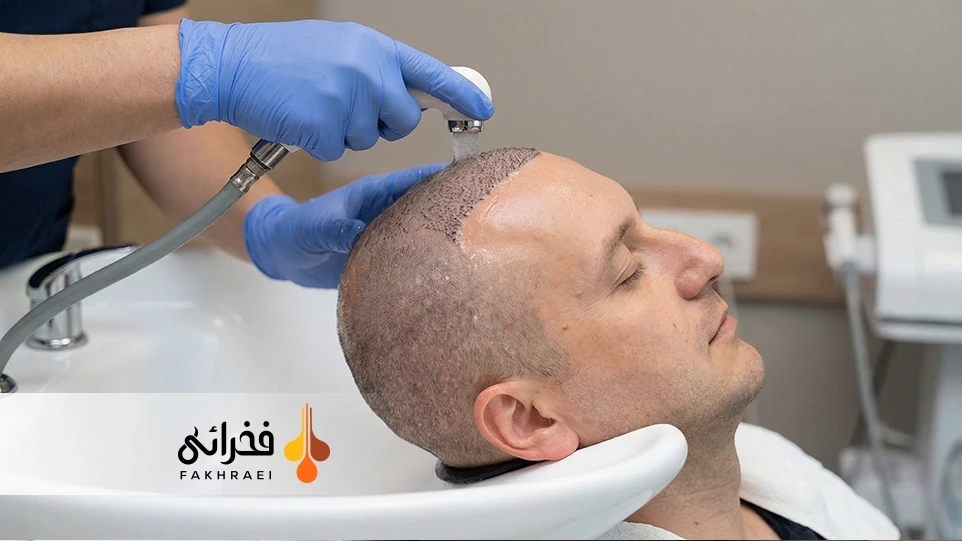 نحوه شستشو سر بعد از کاشت مو