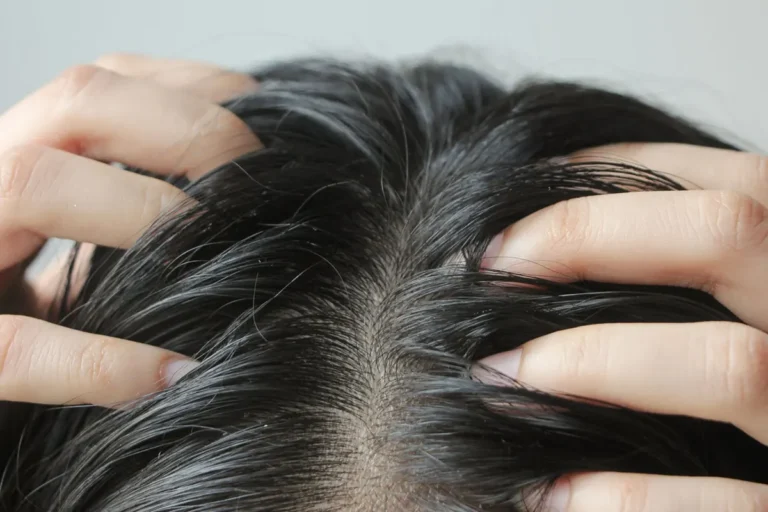 Itchy-Scalp (1)