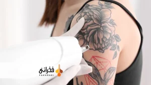 لیزر موهای زائد روی تتو