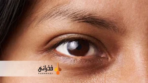 علت سیاهی زیر چشم