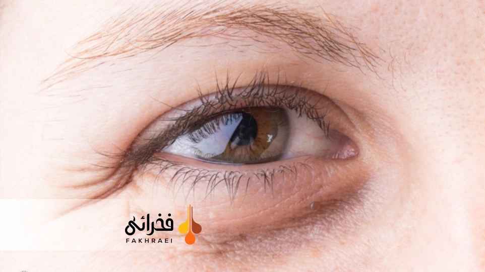 علت سیاهی زیر چشم