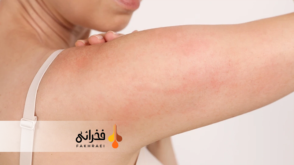 عوارض لیزر موهای زائد