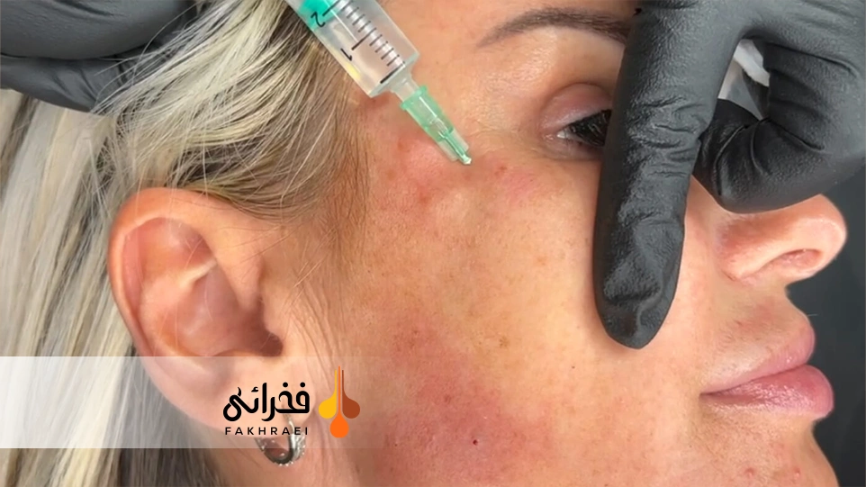 عوارض موقتی تزریق مزوتراپی صورت