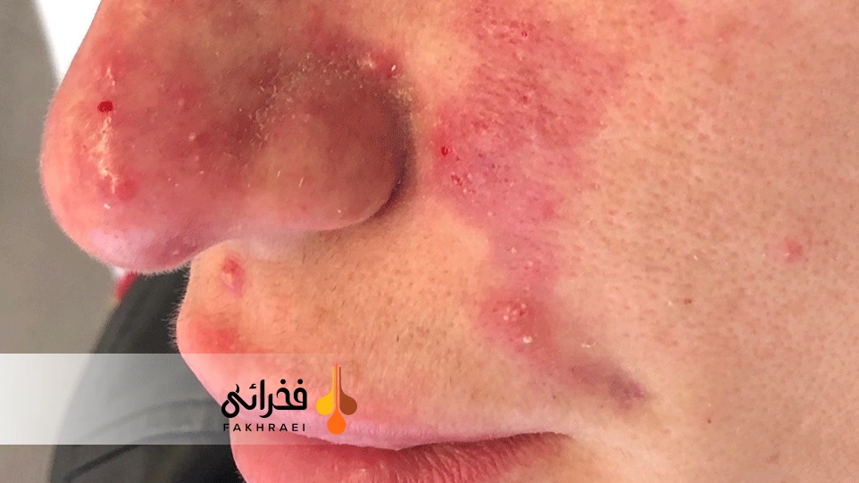 عوارض نادر نکروز پوستی بعد از مزوتراپی پوست